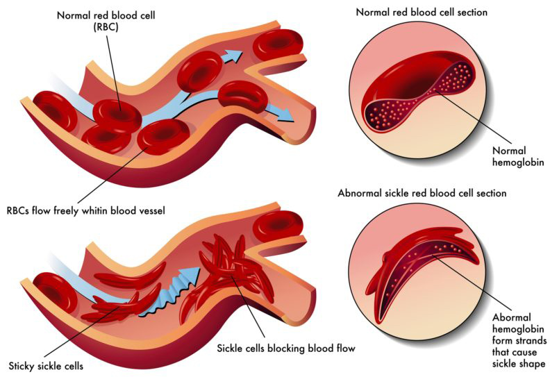 sicklecell